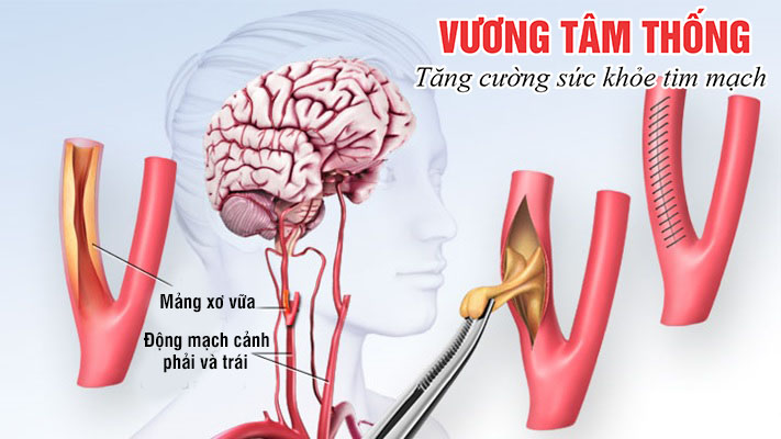 Phẫu thuật cắt bỏ mảng xơ vữa động mạch cảnh.jpg